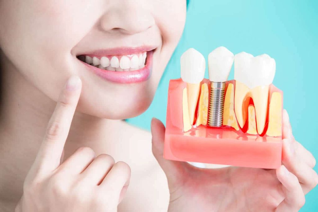 dental implants singapore